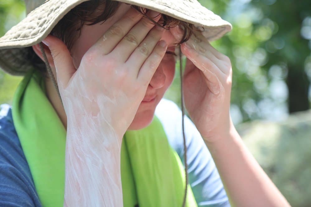 Sunscreen with Ultraviolet Protection Factor 15 or better is recommended.